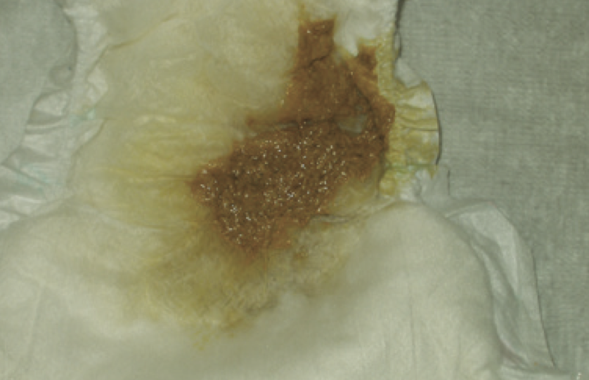 newborn-baby-poo-in-nappies-nct